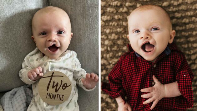 Cleft-Craniofacial Center patient before surgery to repair his cleft lip and cleft palate